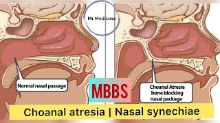 Choanal atresia  Nasal synechiae [upl. by Jacinta]