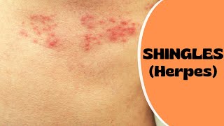 Shingles Symptoms amp Treatment  Eye Shingles  Post Herpetic Neuralgia  Shingles Vaccine [upl. by Ayiotal13]