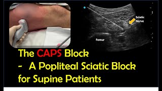 Lateral Popliteal Sciatic Block for Supine Patients CAPS block [upl. by Martreb432]