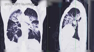 New athome screening offers noninvasive way to detect lung cancer early [upl. by Eelrihs381]