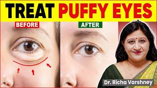 How To Cure Under Eye Bags  Puffy Eyes Home Remedies [upl. by Lenzi]