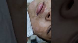 White spots on face in children  pitryiasis alba  home remedies and treatment  calcium deficiency [upl. by Stannfield]