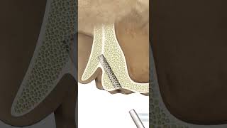 GDT MAX BasalCortical Dental Implant Drilling Protocol [upl. by Yelrebmyk]