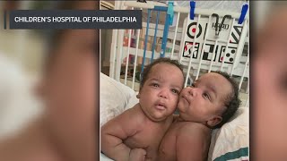 Conjoined twins return home after successful separation surgery at CHOP [upl. by Dilan]