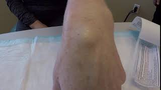 Ganglion cyst aspiration 1 of2 [upl. by Iosep872]