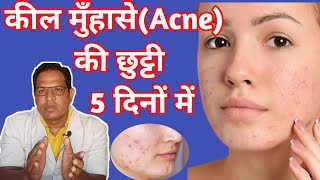 Pimple गायब हो जायंगे  adapalene and clindamycin phosphate gel  Cream For acne and Pimple [upl. by Attenra479]