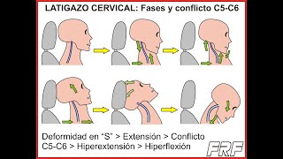 El latigazo cervical whiplash [upl. by Lamoureux107]