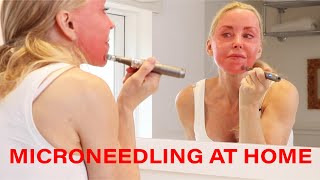 Microneedling DIY at Home  Tips Warnings and Demo  Over 50 [upl. by Nairim]