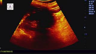 ULTRASOUND OF KIDNEY HANDS ON TRAINING [upl. by Gimble]