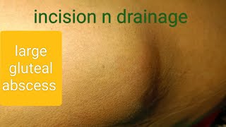 large gluteal abscess  incision n drainage dr youtube doctor [upl. by Llevra]