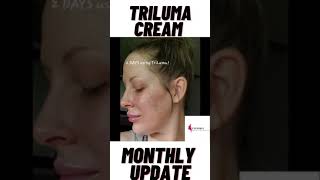 Tri Luma cream Before and After pictures [upl. by Feucht369]