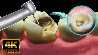 Endodoncia en muela con caries profunda  Tratamiento de conducto [upl. by Narayan766]