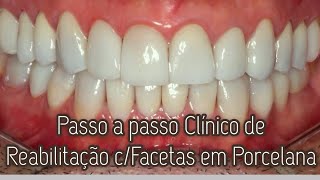 141 FACETAS EM PORCELANA PASSO A PASSO DETALHADO [upl. by Ydospahr589]