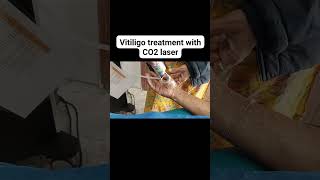 Vitiligo treatment with CO2 laser [upl. by Gascony]