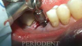 Molar Extraction and Immediate Implant Placement [upl. by Hylan]