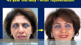 Botox amp Dermal Filler Injection Made Her Young Again  Liquid Facelift Technique [upl. by Ennovehc]