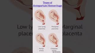 Types of Antepartum Hemorrhage  antepartumhemorrhage viralvideo [upl. by Rosenfeld]