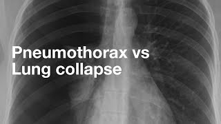 Pneumothorax vs Lung Collapse [upl. by Stargell541]