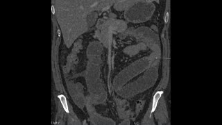 Adhesions causing small bowel obstruction  CT findings [upl. by Ludwig84]