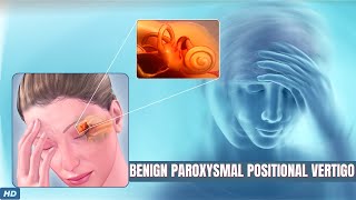 Benign Paroxysmal Positional Vertigo What You Need To Know [upl. by Barn237]