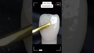 The Art of Anterior Composite Restoration precisiondentistry dentalinnovation 3dprintingdentist [upl. by Ailimat]