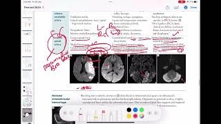 Anterior spinal artery stroke neurology 78  First Aid USMLE Step 1 in UrduHindi [upl. by Pournaras]