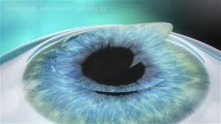 LASIK Eye Surgery Animation [upl. by Hartman]