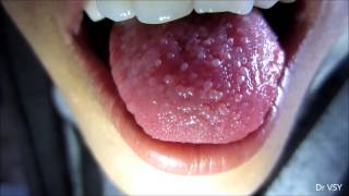 Papillitis Tongue [upl. by Benita2]