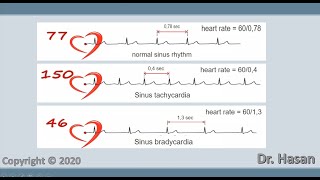 Sinus arrhythmia  tachycardia bradycardia and respiratory arrhythmia [upl. by Gnuhp]