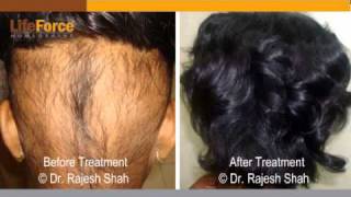 Alopecia Areata Successful Treatment Using Homeopathy [upl. by Sivrep]