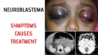 NEUROBLASTOMA Symptoms Signs Causes Treatment [upl. by Brendis]