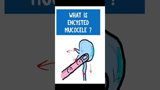 ENCYSTED MUCOCELE  Chronic dacryocystitis opthalmology [upl. by Ellenij]