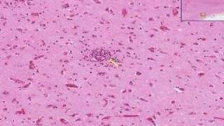 Histopathology Brain Viral encephalitis [upl. by Orest]