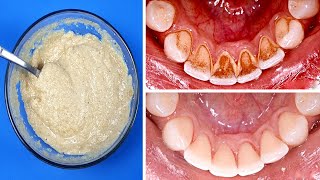 Ce Mélange Va Enlever La Plaque Des Dents En 5 Minutes Et Vous Nirez Plus Chez Dentiste [upl. by Kcirdahc]