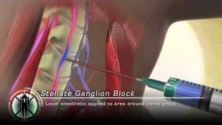 Stellate Ganglion Block Injection [upl. by Eirrahs]