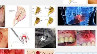 wieso die Wurzelspitzenresektion meistens nichts bringt [upl. by Aseiram693]