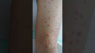 Guttate psoriasis  psoriasis skin psoriasisawareness psoriasissolution dermestidscanada short [upl. by Mehsah899]