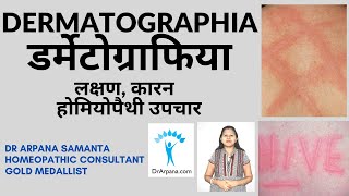 डर्मेटोग्राफिया हाइव्स लक्षण उपचार और कारण  DERMATOGRAPHIA Urticaria amp Homeopathic Treatment [upl. by Archle1]