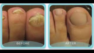 How Long Should I Take Lamisil For Toenail Fungus  Quickest Way To Remove Toenail Fungus [upl. by Garek]