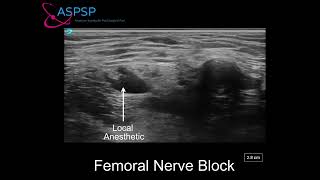 Ultrasound Guided Femoral Nerve Block In a Patient With Vascular Stent [upl. by Rimidalg]