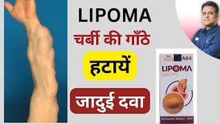 Lipoma ki best homeopathy medicine । लिपोमा ठीक करे बिना ऑपरेशन । [upl. by Eirased]