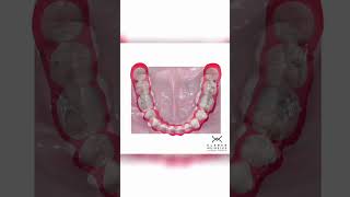 ORTHODONTIC SPACE CLOSURE  ORTHODONTIC TIPS Shorts [upl. by Ettelracs]