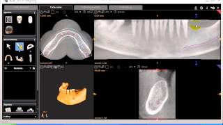 Tutorial CS 3D imaging software 09Carestream Herramienta de medidasavi [upl. by Rogerg]