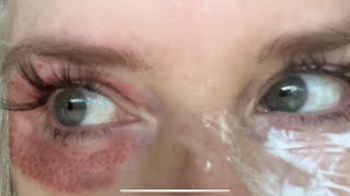 Plasma fibroblast at home to tighten loose skin under the eyes and also in the eyelids [upl. by Dottie]