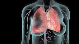 DVT and Pulmonary Embolism  Nucleus Health [upl. by Silisav675]