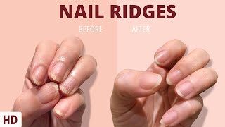 Nail Ridges The Silent Signaling Your Nails Are Trying to Tell You [upl. by Aeret]