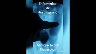 Enfermedad de Hirschsprung microrecto con megacolon en Colón por enema [upl. by Archibaldo706]