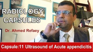 Capsule  11 Ultrasound of Acute Appendicitis [upl. by Atekahs]