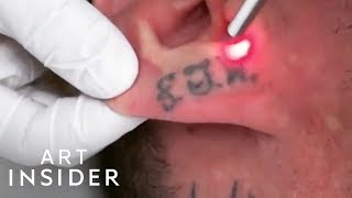 How Tattoo Removal Works [upl. by Faber]