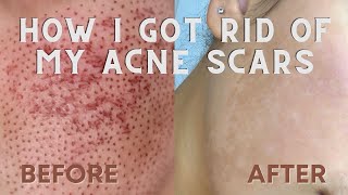 HOW I GOT I GOT RID OF MY ACNE SCARS  Fibroblast Skin Tightening Before and After [upl. by Narak40]